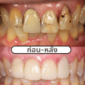 รีวิวจากลูกค้า คลินิกทันตกรรม Little Tooth Dental Clinic ปิ่นเกล้า