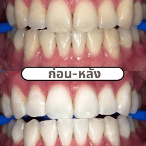 รีวิวจากลูกค้า คลินิกทันตกรรม Little Tooth Dental Clinic ปิ่นเกล้า