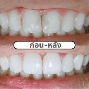 รีวิวจากลูกค้า คลินิกทันตกรรม Little Tooth Dental Clinic ปิ่นเกล้า