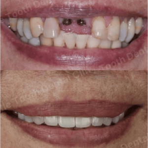 รีวิวจากลูกค้า คลินิกทันตกรรม Little Tooth Dental Clinic ปิ่นเกล้า