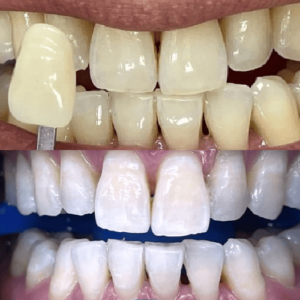 รีวิวจากลูกค้า คลินิกทันตกรรม Little Tooth Dental Clinic ปิ่นเกล้า