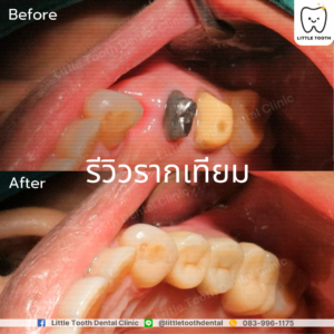 รีวิวจากลูกค้า คลินิกทันตกรรม Little Tooth Dental Clinic ปิ่นเกล้า